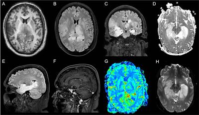 Case Report: Brain tumor’s pitfalls: two cases of high-grade brain tumors mimicking autoimmune encephalitis with positive onconeuronal antibodies